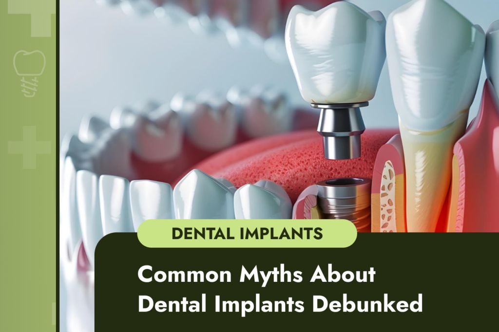 Myths About Dental Implants