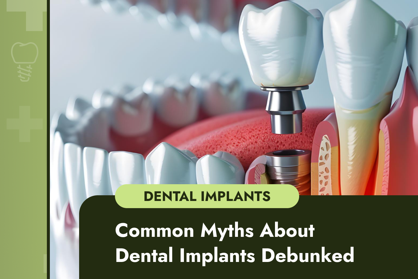 Common Myths About Dental Implants Debunked