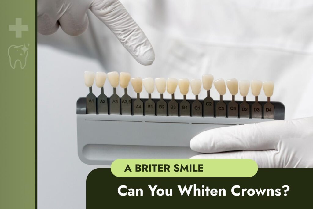 Veneers vs. Crowns | Choose the best option